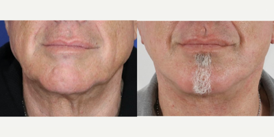 Lower Facelift before and after photo