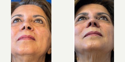 Revision Rhinoplasty before and after photo