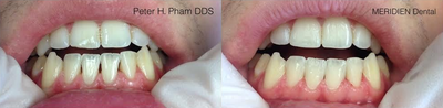 Smile Makeover before and after photo