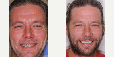 All-on-4 Dental Implants before and after photo