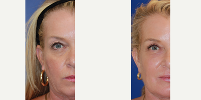 CO2 Laser before and after photo