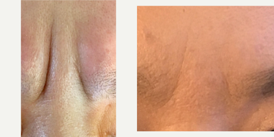 Dysport before and after photo