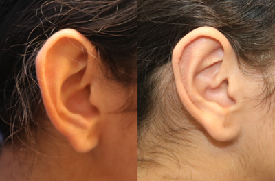 Ear Surgery before and after photo