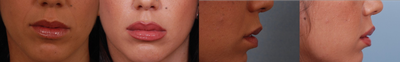 Lip Fillers before and after photo