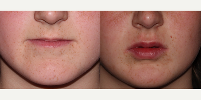 Lip Fillers before and after photo