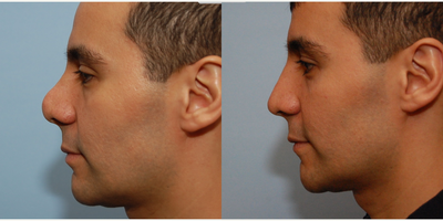 Revision Rhinoplasty before and after photo