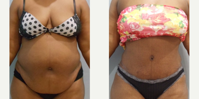 Tummy Tuck before and after photo