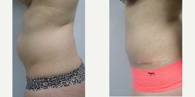 Tummy Tuck before and after photo