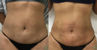 BodyTite before and after photo