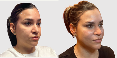 Botox before and after photo