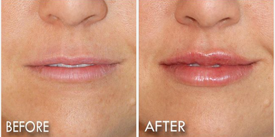 Restylane before and after photo