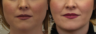 Buccal Fat Removal before and after photo