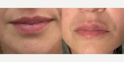 Dermal Fillers before and after photo