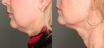 Ultherapy before and after photo