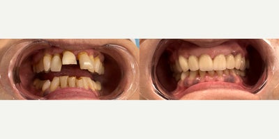 All-on-4 Dental Implants before and after photo