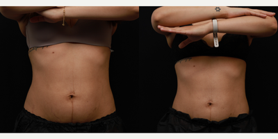 Emsculpt before and after photo