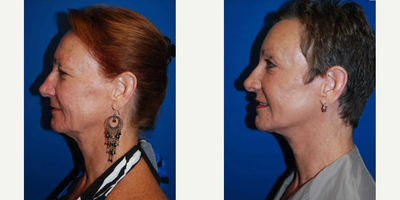 Facelift before and after photo