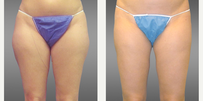 Laser Liposuction before and after photo