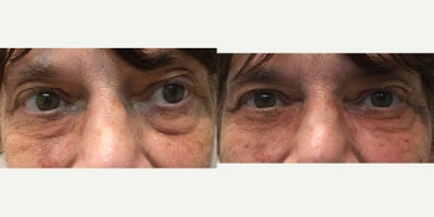Restylane before and after photo