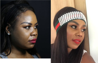 African American Rhinoplasty before and after photo