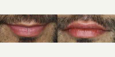 Belotero before and after photo