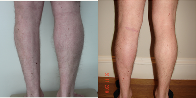 Calf Implant before and after photo