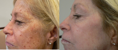 CO2 Laser before and after photo