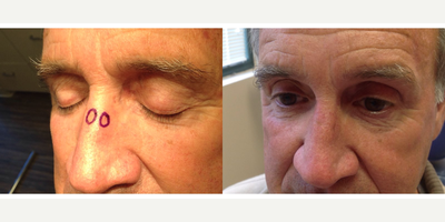 Mohs Surgery before and after photo