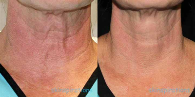 Nonsurgical Neck Lift before and after photo