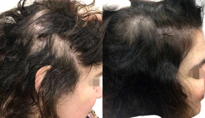 PRP for Hair Loss before and after photo