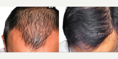 PRP for Hair Loss before and after photo