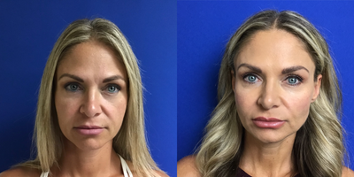 Restylane Defyne before and after photo