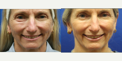 Sculptra before and after photo
