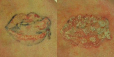 Tattoo Removal before and after photo