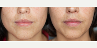 Botox before and after photo