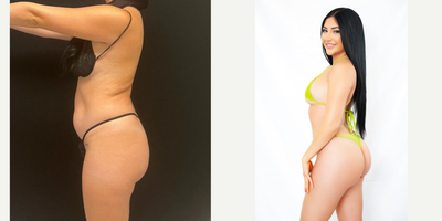 Brazilian Butt Lift before and after photo