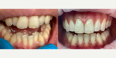 Dental Bonding before and after photo