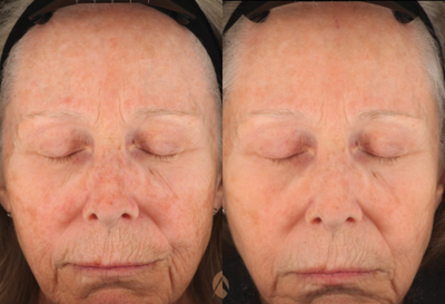 Fraxel Laser before and after photo