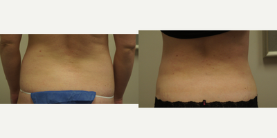 Liposuction before and after photo