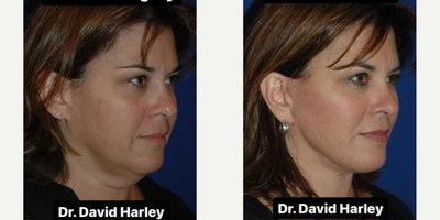 Neck Lift before and after photo