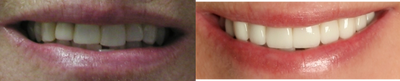 Porcelain Veneers before and after photo
