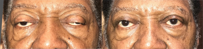 Ptosis Surgery before and after photo
