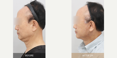 Botox before and after photo