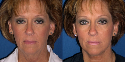 Facelift before and after photo