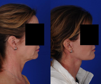 Facelift before and after photo