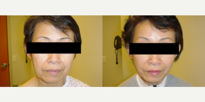 Facelift before and after photo
