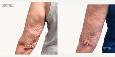 Morpheus8 before and after photo
