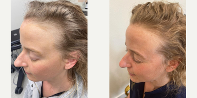 PRP Injections before and after photo