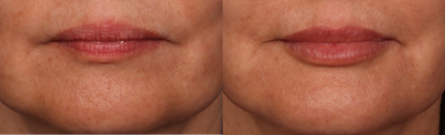Volbella before and after photo