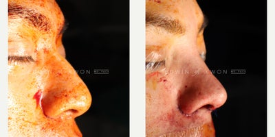 Asian Rhinoplasty before and after photo
